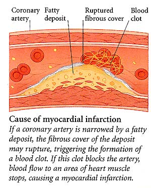 Myocardial infraction